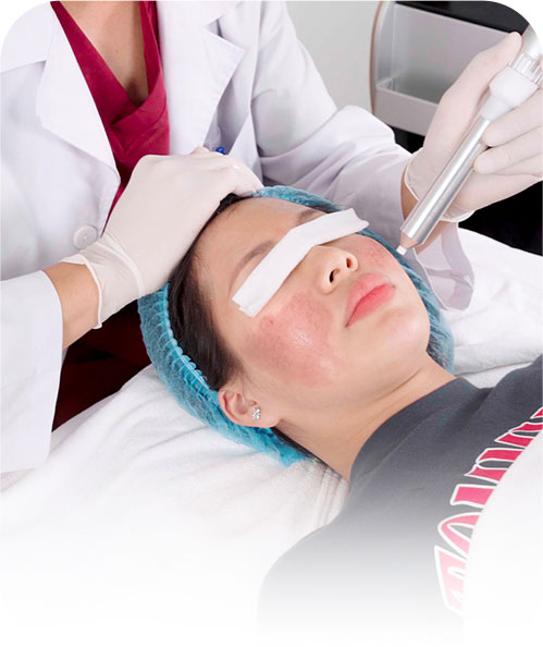 Trị thâm vùng mắt