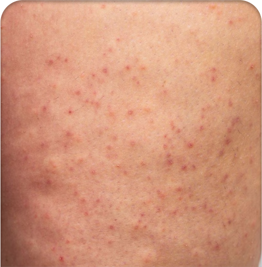 Điều trị viêm nang lông