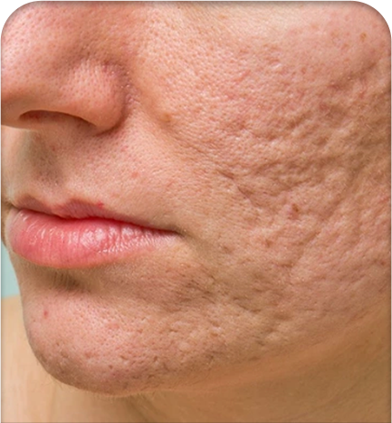 Điều trị sẹo rỗ