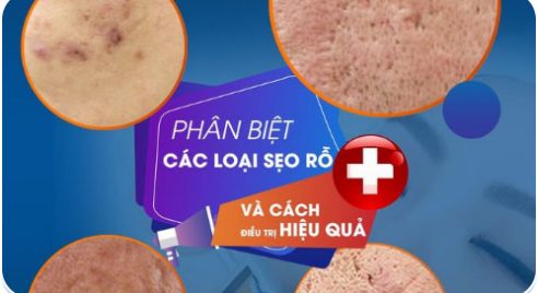 Thu Gọn Cánh Mũi An Toàn